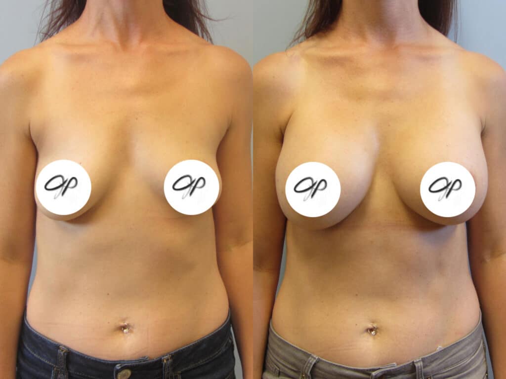 A Natural Look of Symmetric Breasts: Augmentation with Fat Transfer