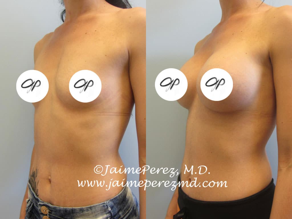 Extra High Profile Implants for Breast Augmentation