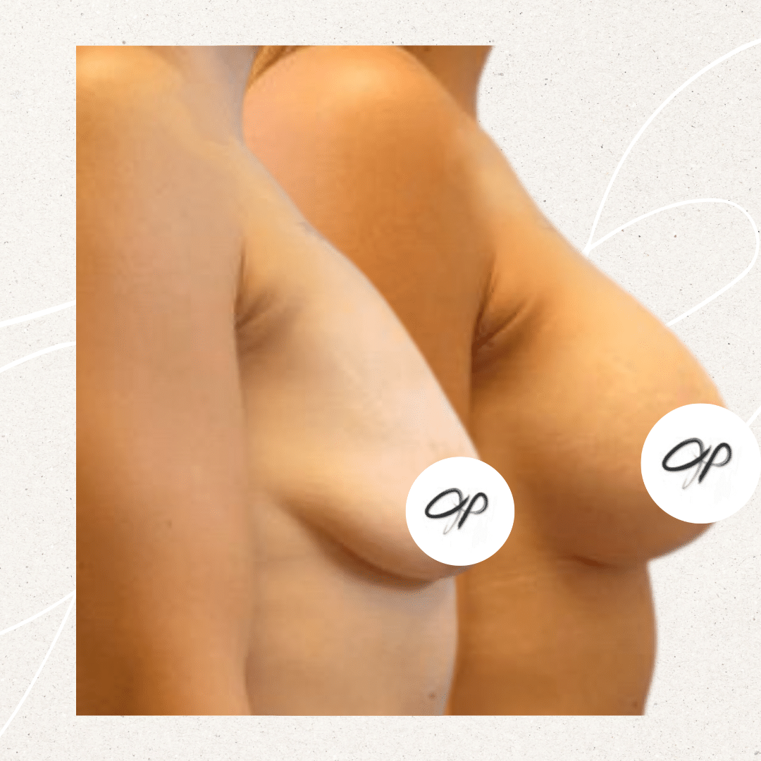 Considering a Breast Lift? Check out these Results!