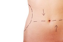 Tampa Extended Tummy Tuck Technique