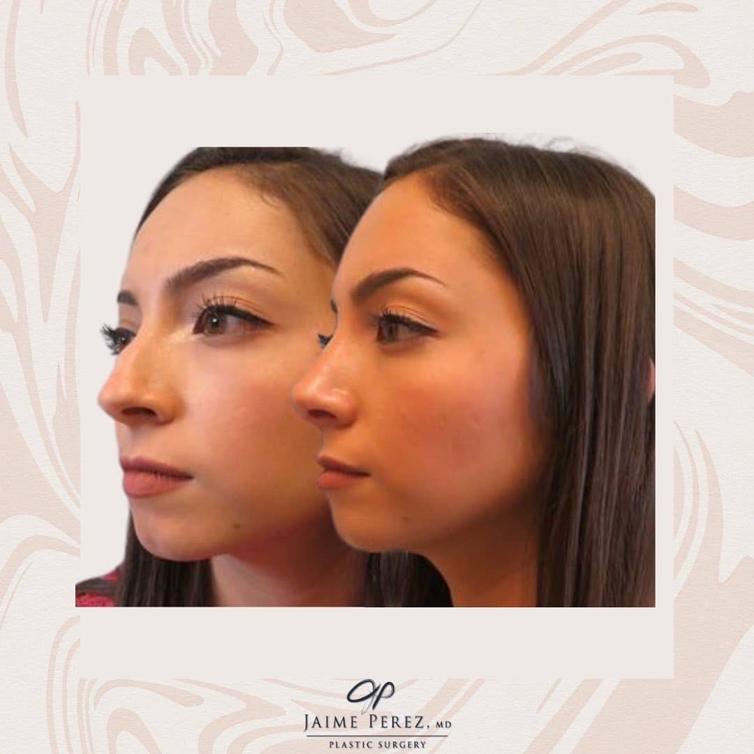 Are you thinking about getting a Rhinoplasty?