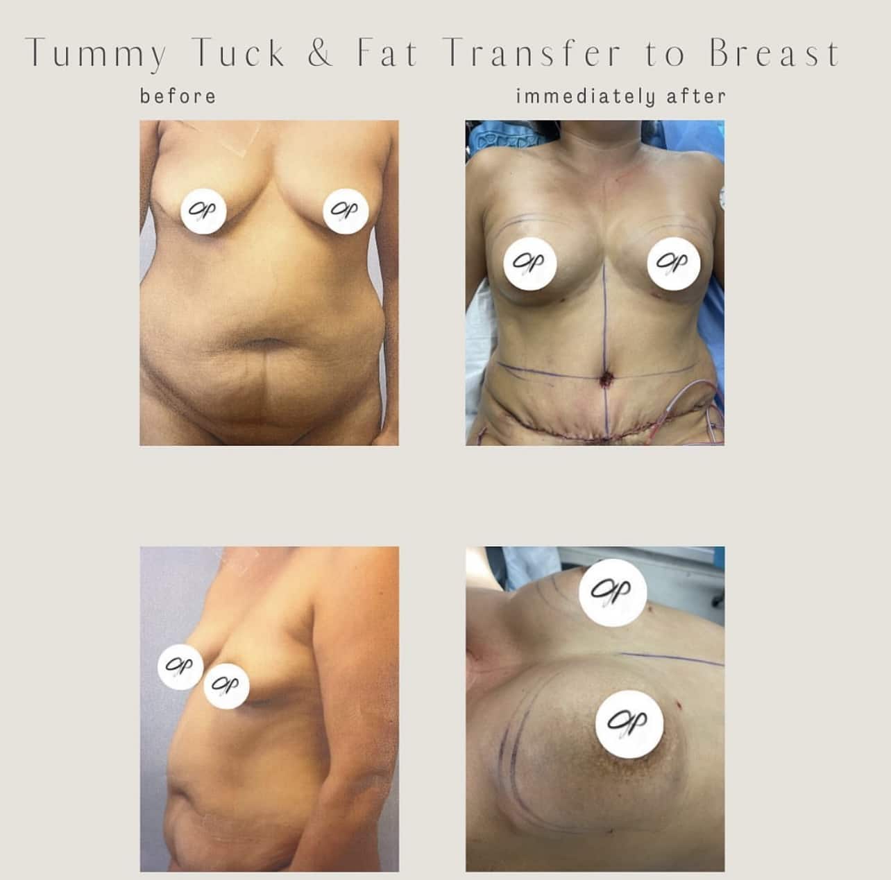 Check out the results of this tummy tuck & fat transfer to breast!!