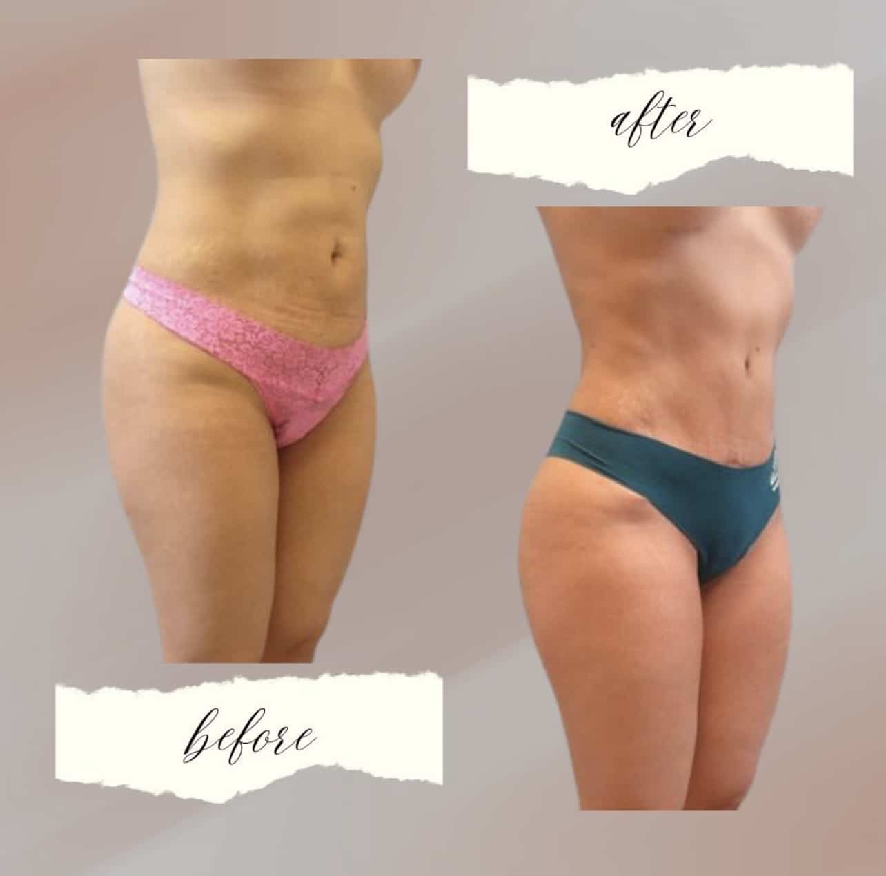 Liposuction strategically used to create a snatched and lifted effect!