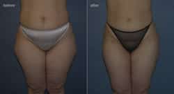 Liposuction – Benefits of Body Sculpting