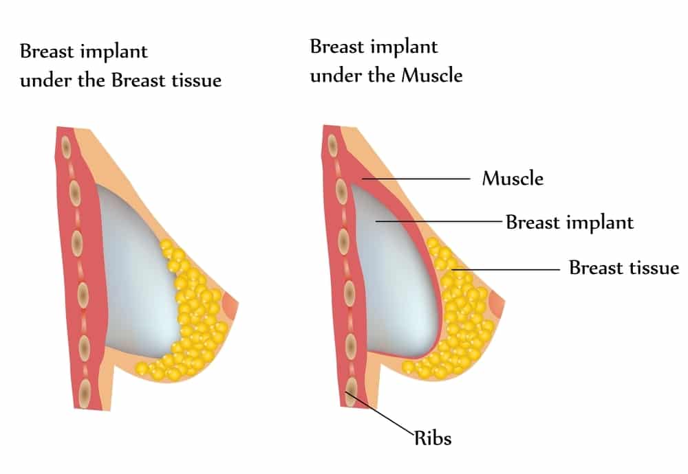 Breast Implant Placement-What will my Implants look like?