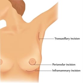 Learn about the Right Implant and Breast Augmentation Incision Type for you