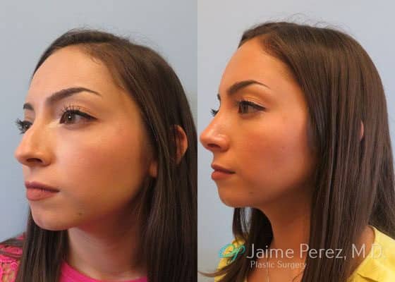 Patient Rhinoplasty