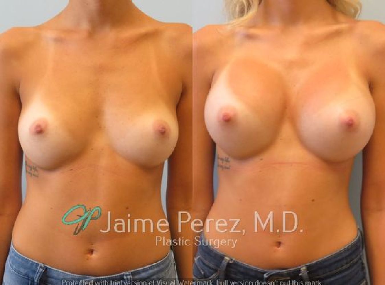 Breast Augmentation Before & After