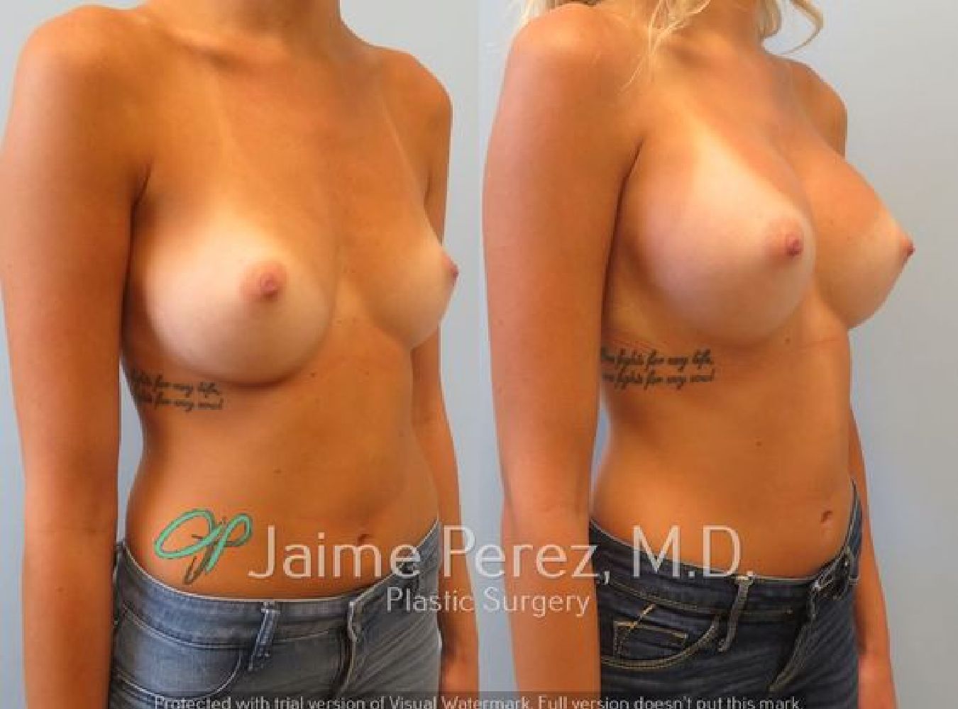 Breast Augmentation Before & After Oblique