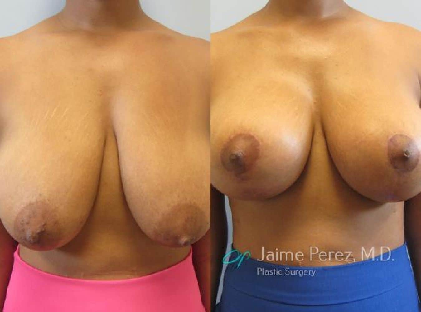 Breast Lift Before and After