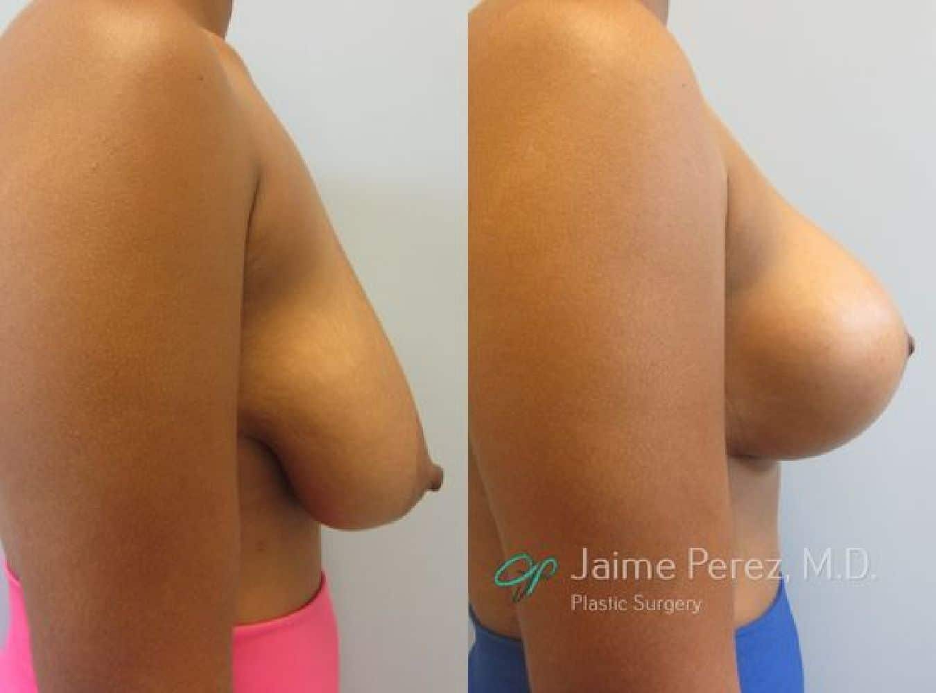 Breast Lift Before and After Profile