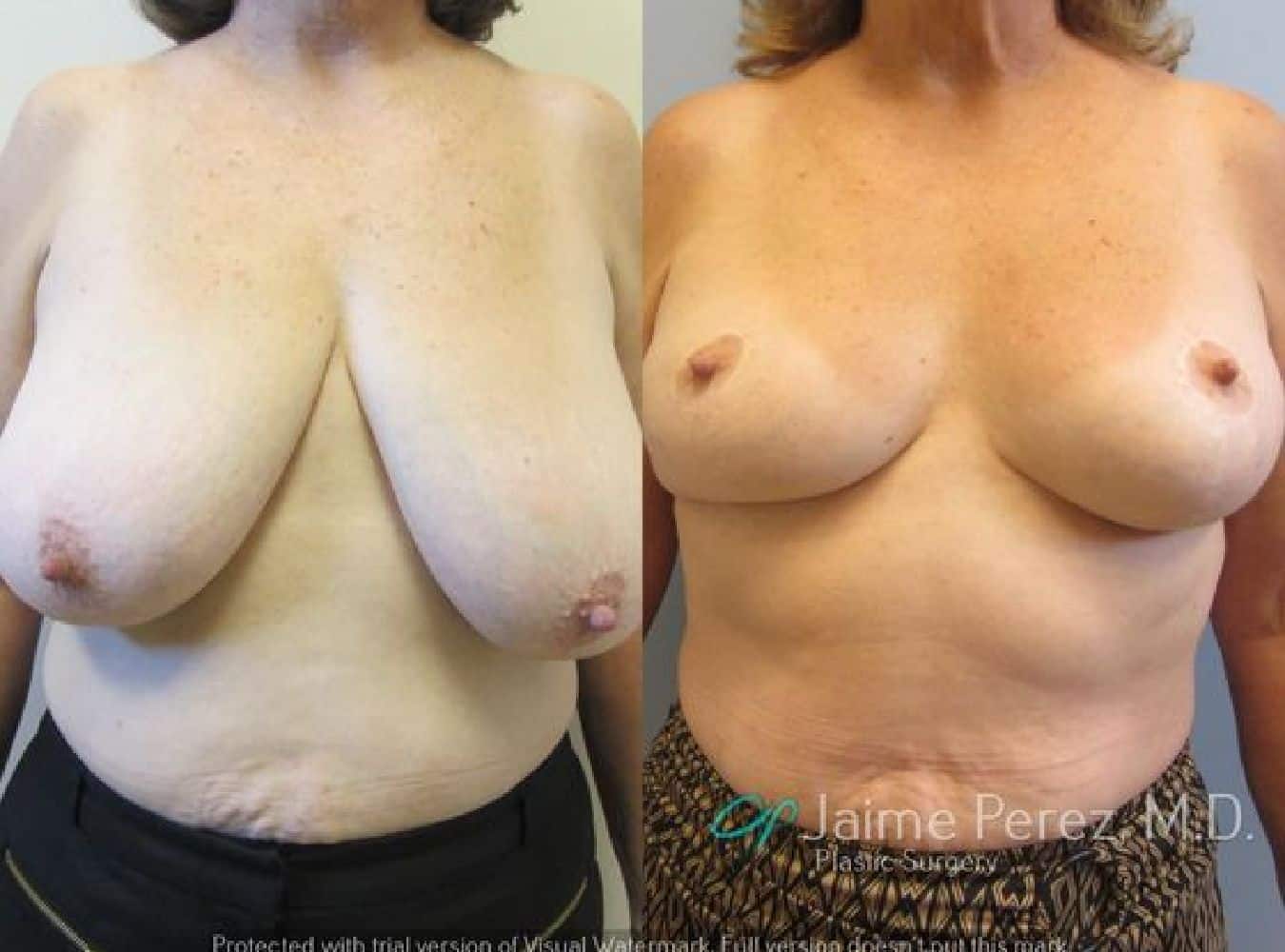 Breast Reduction Before and After