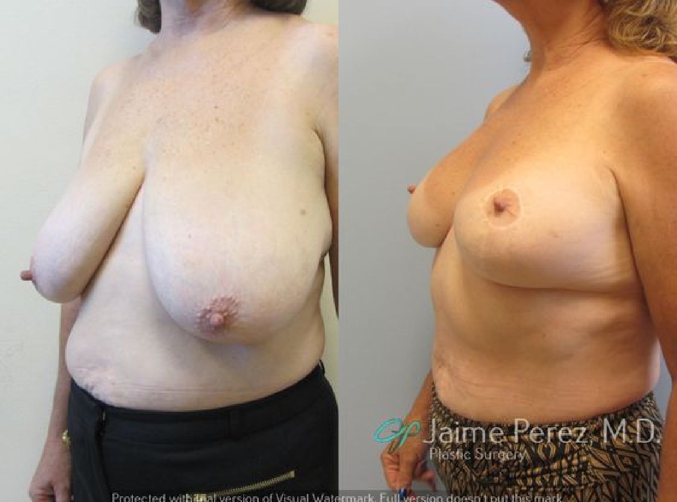 Breast Reduction Before and After Oblique