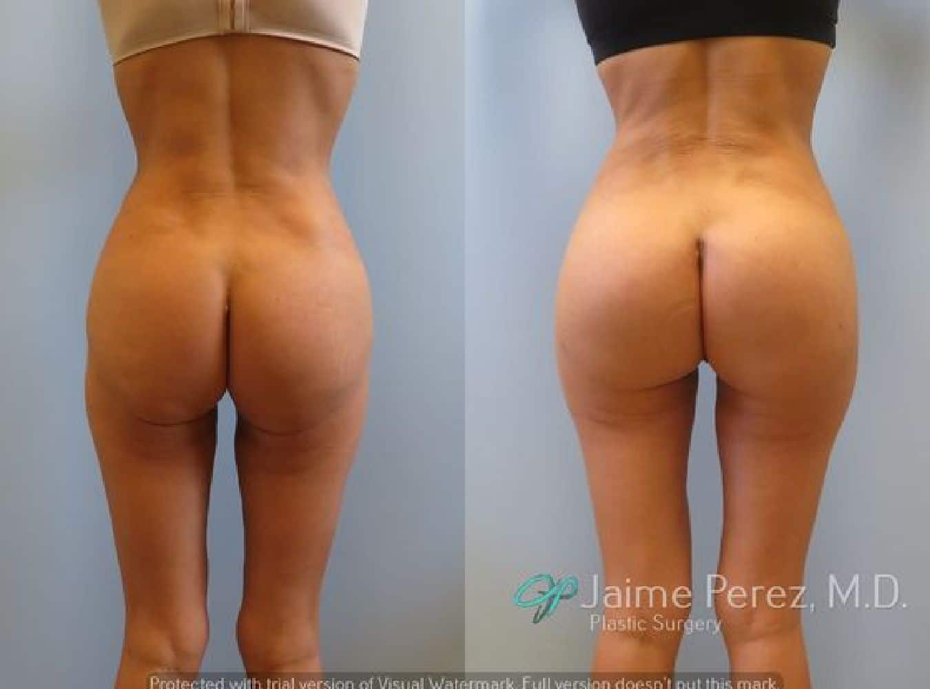 Butt Augmentation Before and After Profile