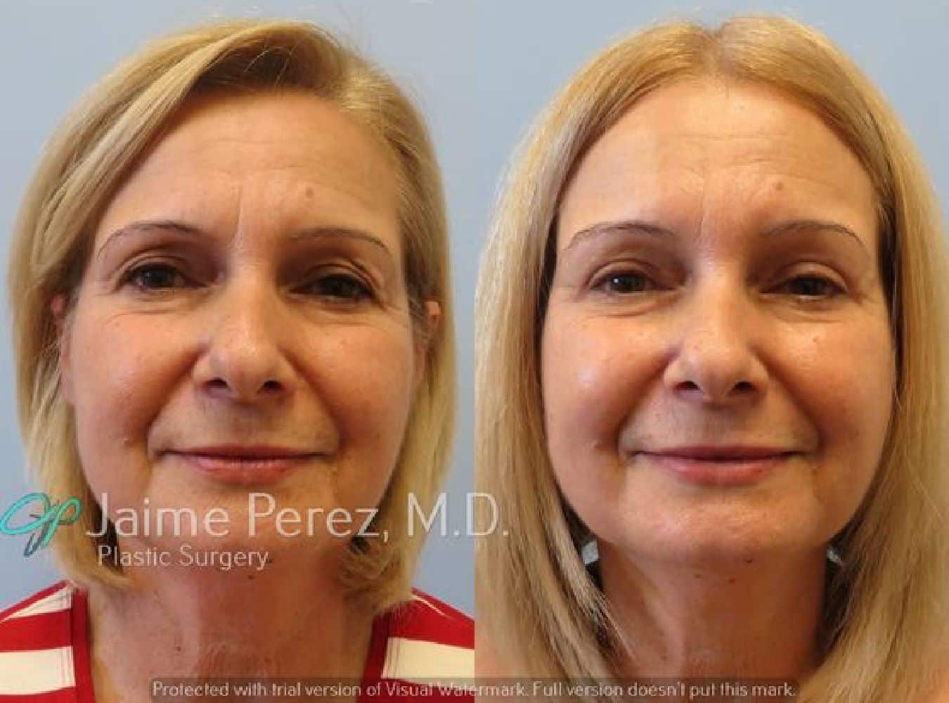 Eyelid Surgery Before and After