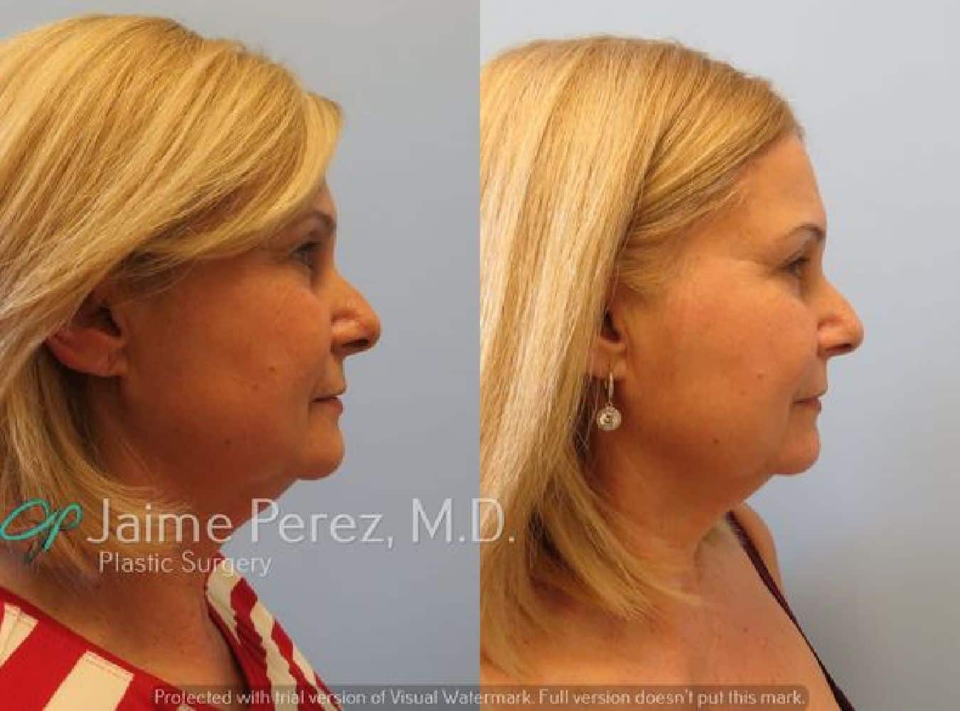 Eyelid Surgery Before and After Profile