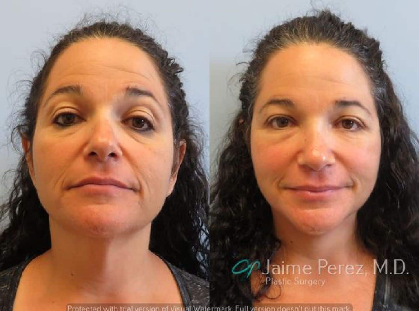 Facelift Surgery before and after