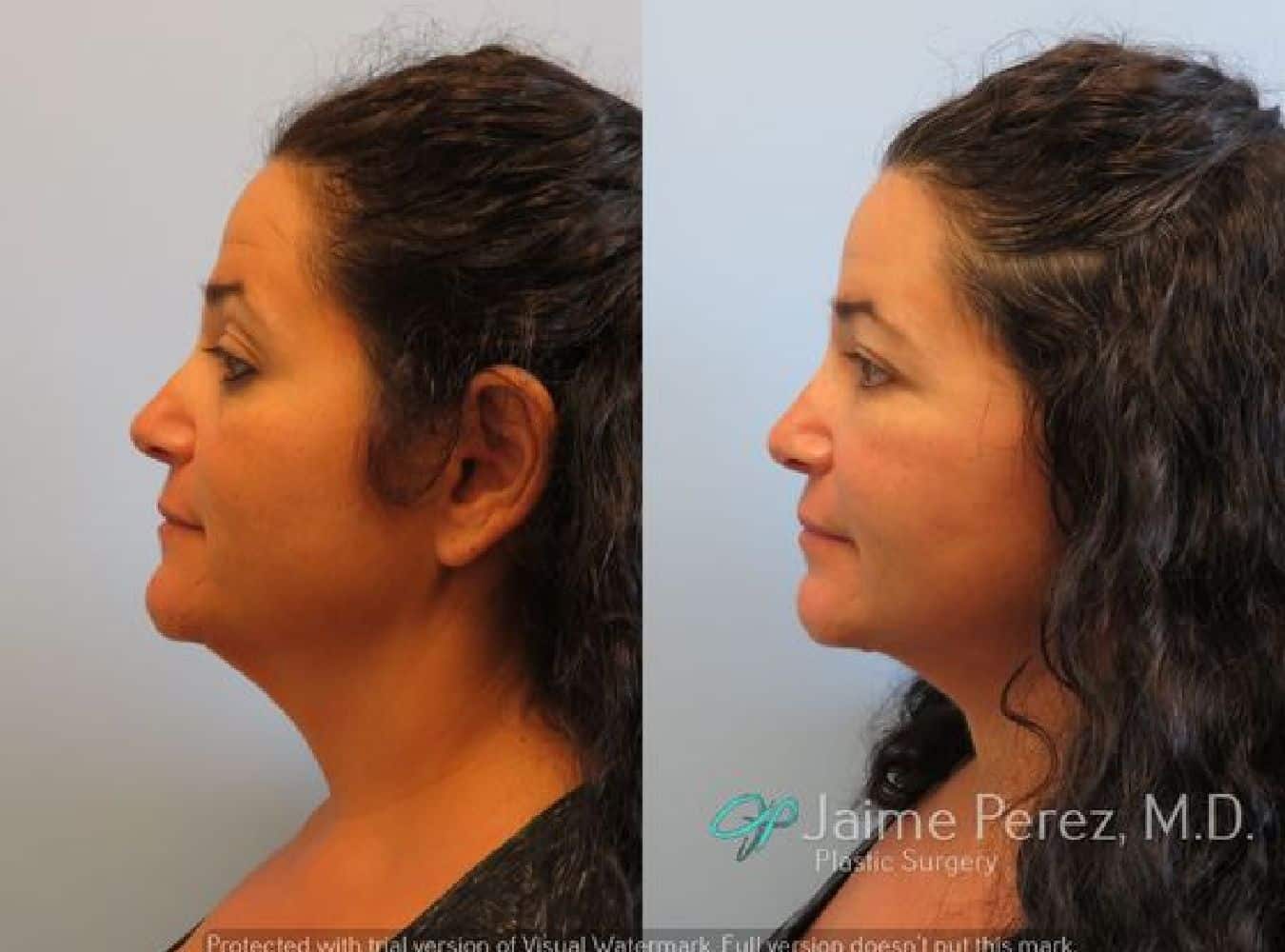 Facelift Surgery Profile before and after