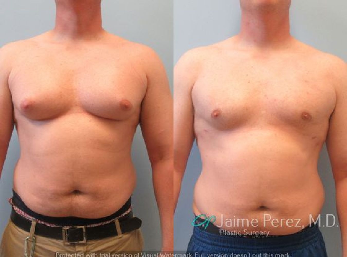 Male Breast Reduction Front View