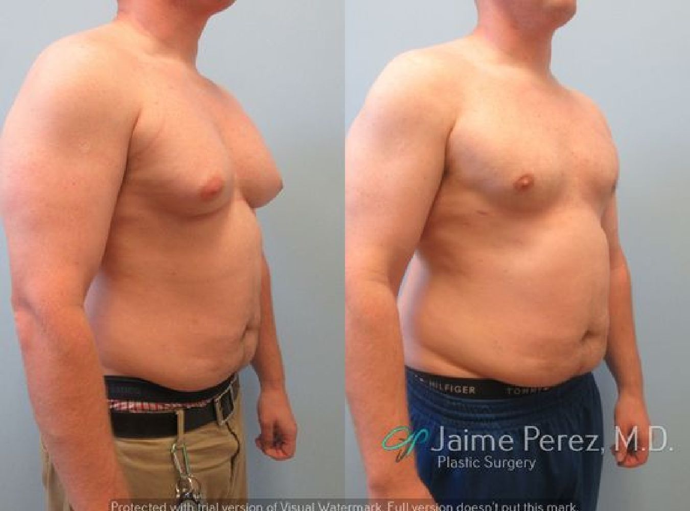 Male Breast Reduction Oblique View