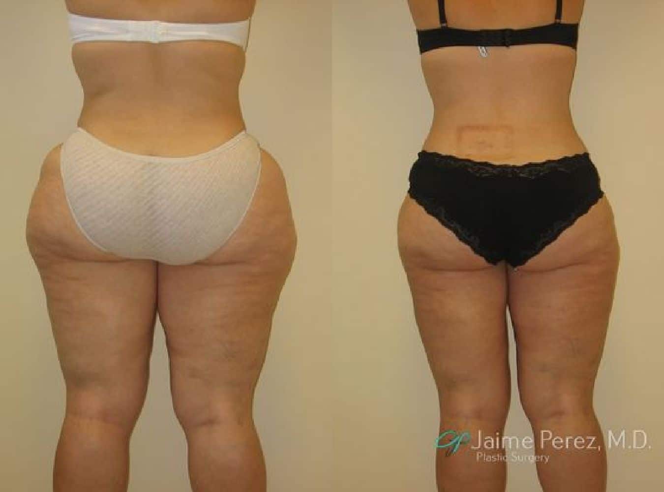 Liposuction Before and After Back