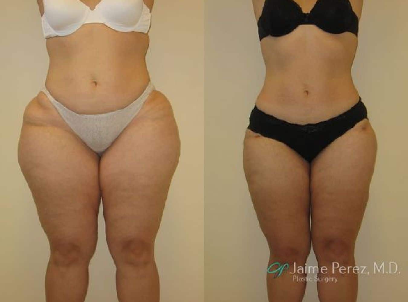 Liposuction Before and After Front