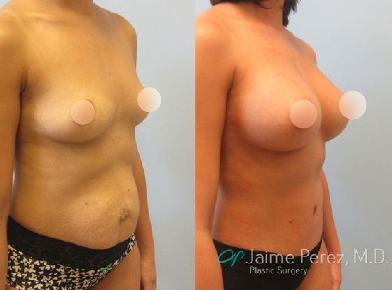 Mommy Makeover Before & After Oblique