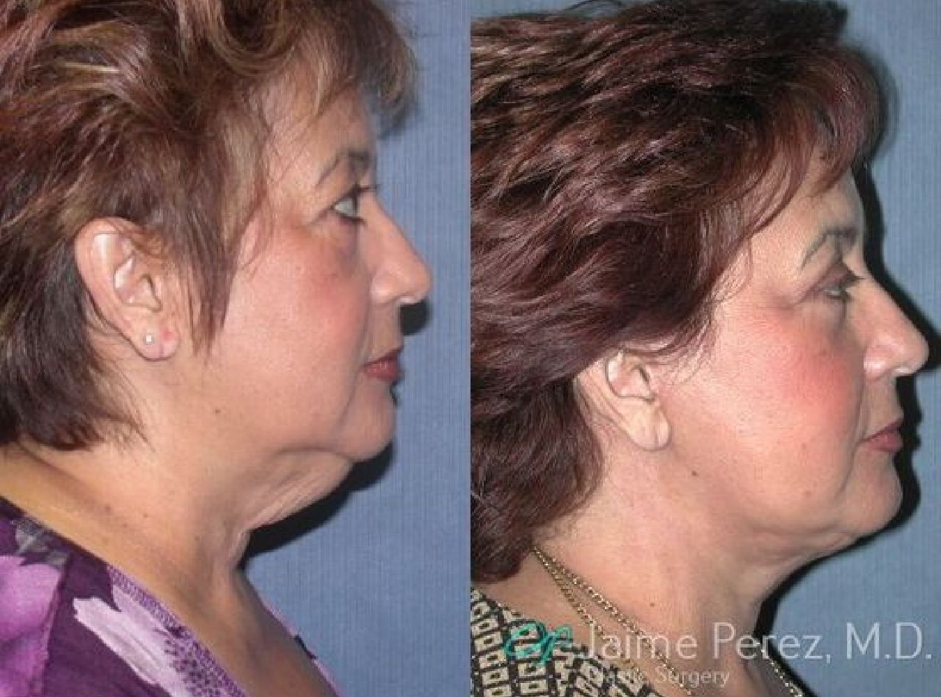 Neck Lift Surgery before and after