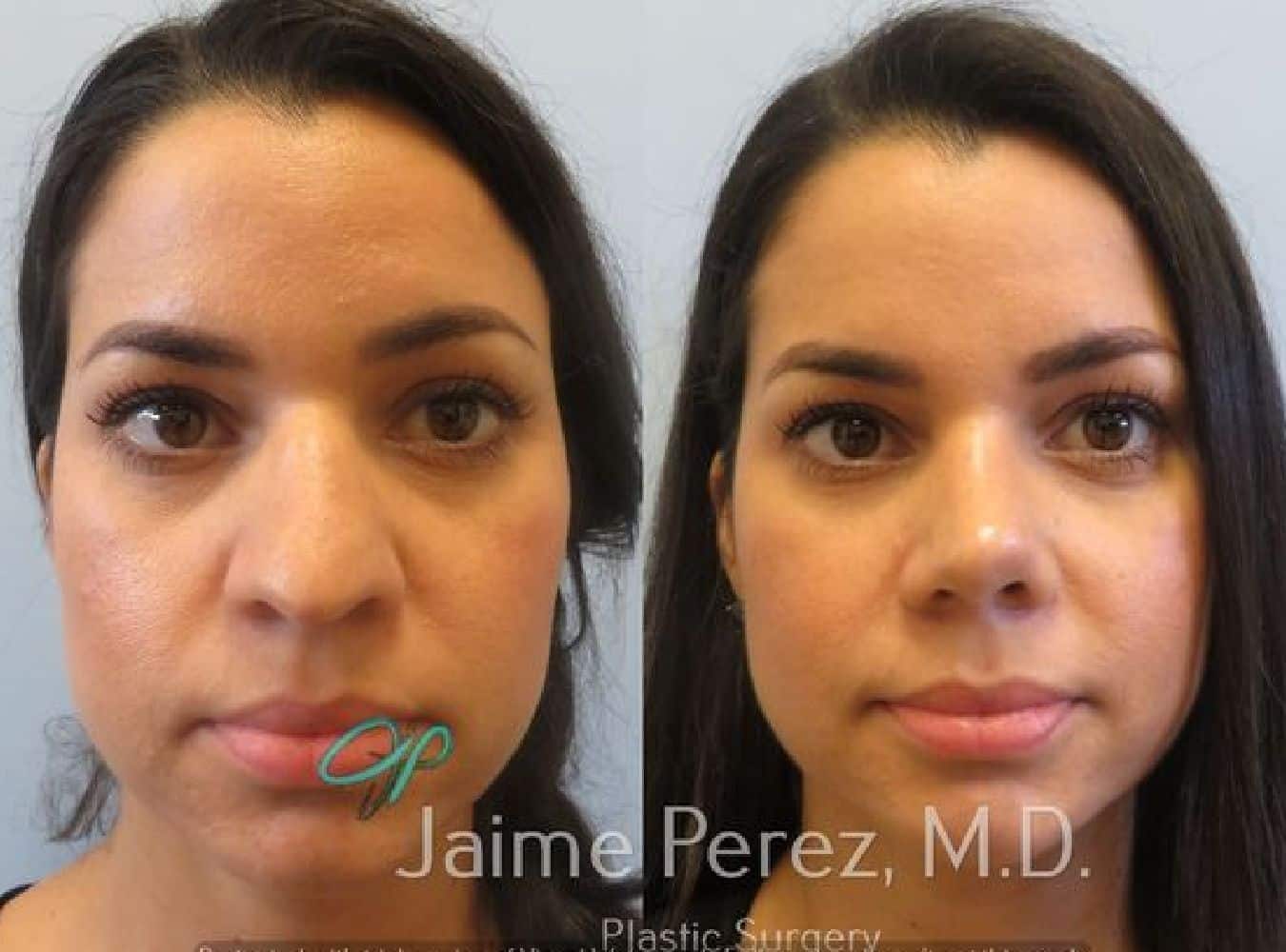 Rhinoplasty/Nose Surgery Before Front View