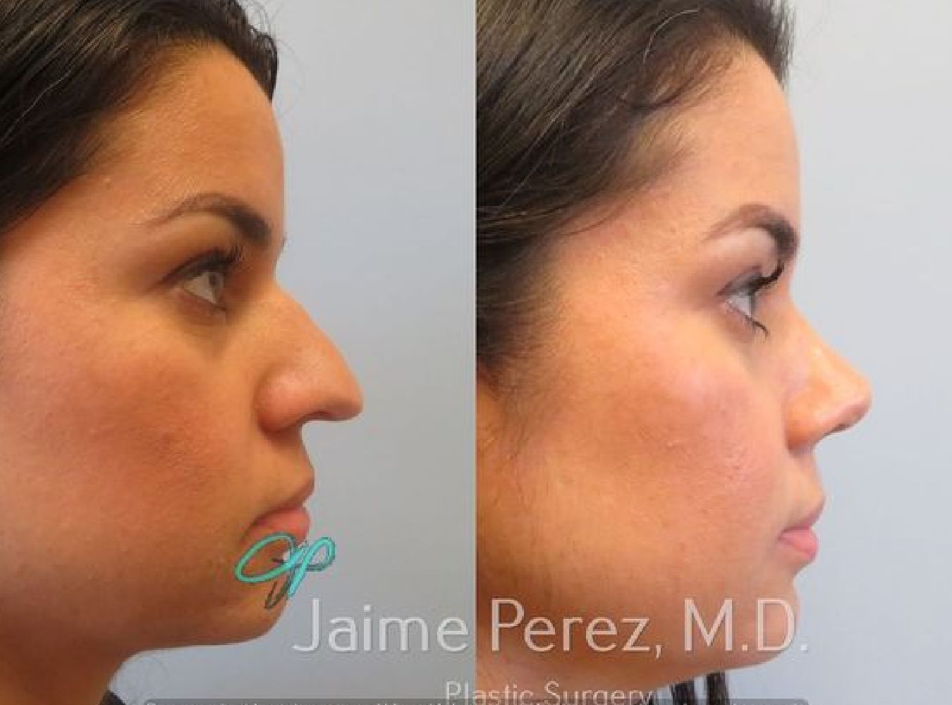 Rhinoplasty/Nose Surgery Before Profile View