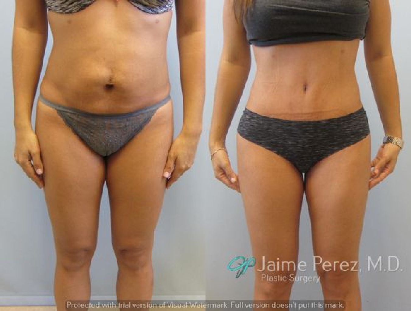 Tummy Tuck Before and After 1