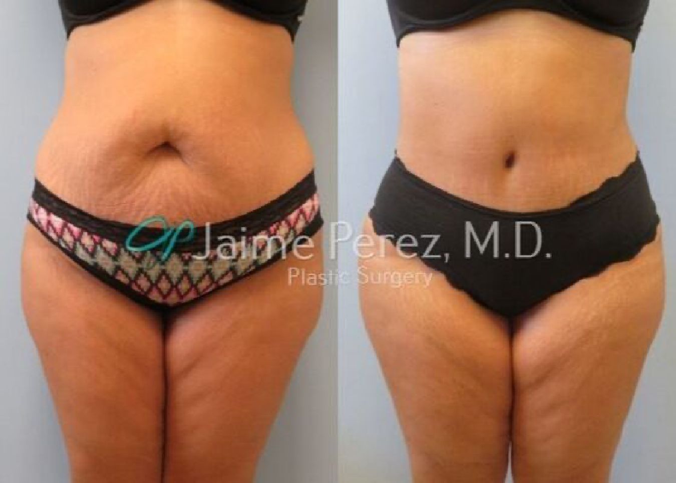 Tummy Tuck Before and After 2